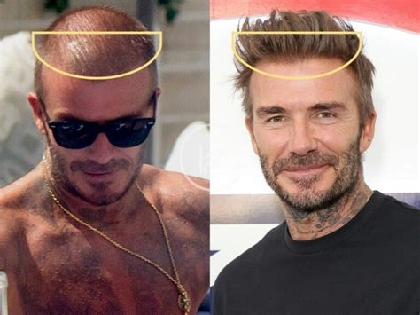 Balding Male Celebrities Who've Had Hair Transplant Surgery.
